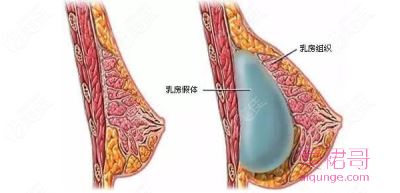 3种巧妙健胸法 造傲人身材
