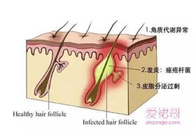 祛痘：中西医夹攻更有效