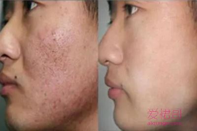 循序渐进四步洗脸法去青春痘